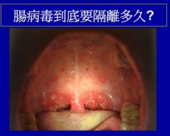 腸病毒到底要隔離多久?